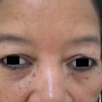 Eyelid Surgery Before & After Patient #3670