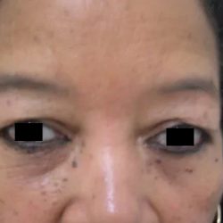Eyelid Surgery Before & After Patient #3670