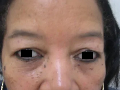 Eyelid Surgery Before & After Patient #3670