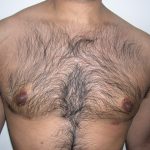 Gynecomastia Before & After Patient #3874