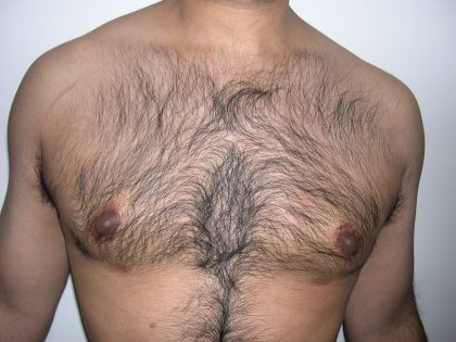 Gynecomastia Before & After Patient #3874