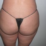 Buttock Augmentation Before & After Patient #3769
