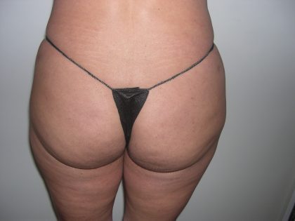 Buttock Augmentation Before & After Patient #3769