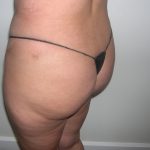Buttock Augmentation Before & After Patient #3769