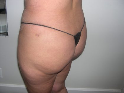 Buttock Augmentation Before & After Patient #3769
