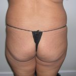 Buttock Augmentation Before & After Patient #3769