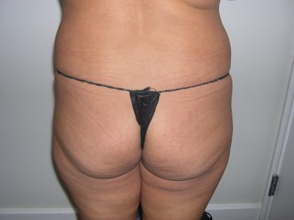 Buttock Augmentation Before & After Patient #3769