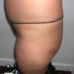 Buttock Augmentation Before & After Patient #3769