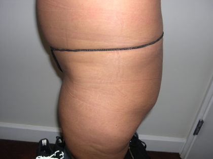 Buttock Augmentation Before & After Patient #3769