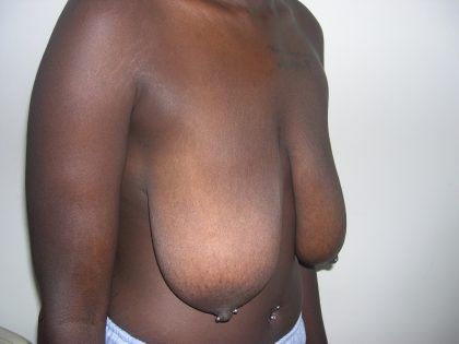 Breast Reduction Before & After Patient #3743