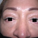 Eyelid Surgery Before & After Patient #3671