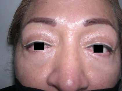 Eyelid Surgery Before & After Patient #3671