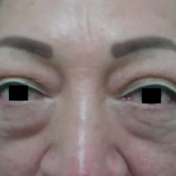 Eyelid Surgery Before & After Patient #3671