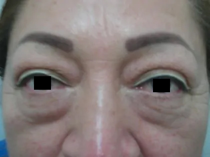 Eyelid Surgery Before & After Patient #3671