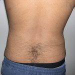 Liposuction Male Before & After Patient #3888
