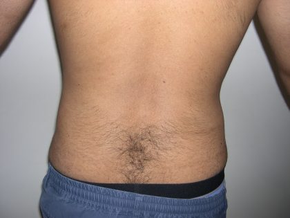 Liposuction Male Before & After Patient #3888