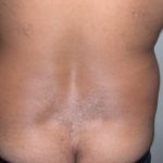 Liposuction Male Before & After Patient #3888