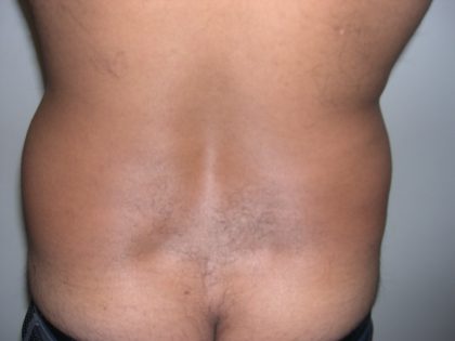 Liposuction Male Before & After Patient #3888