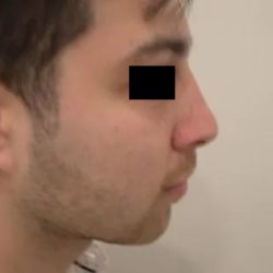 Rhinoplasty Male Before & After Patient #3907