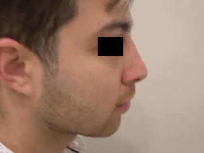 Rhinoplasty Male Before & After Patient #3907