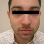 Rhinoplasty Male Before & After Patient #3907