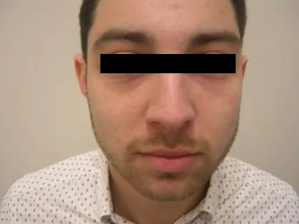 Rhinoplasty Male Before & After Patient #3907