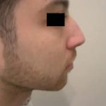 Rhinoplasty Male Before & After Patient #3907