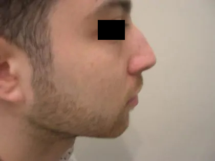 Rhinoplasty Male Before & After Patient #3907