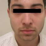 Rhinoplasty Male Before & After Patient #3907