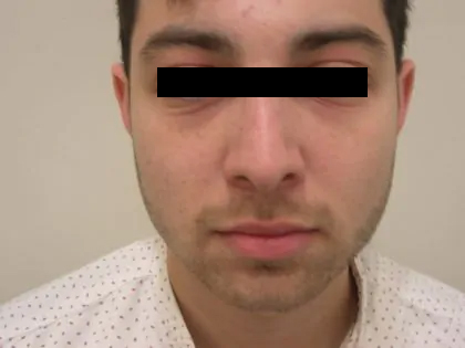 Rhinoplasty Male Before & After Patient #3907