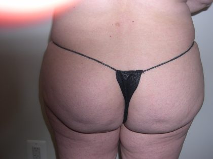 Buttock Augmentation Before & After Patient #3774