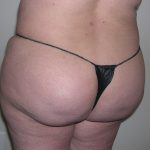 Buttock Augmentation Before & After Patient #3774