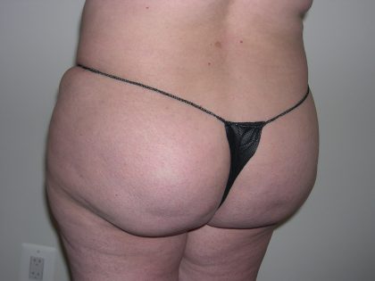 Buttock Augmentation Before & After Patient #3774