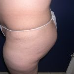 Buttock Augmentation Before & After Patient #3774