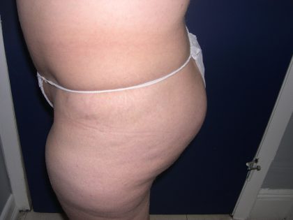 Buttock Augmentation Before & After Patient #3774