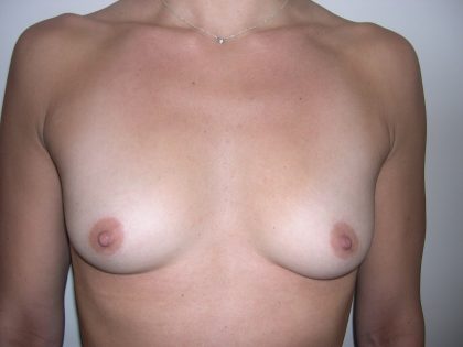 Breast Augmentation Before & After Patient #3685
