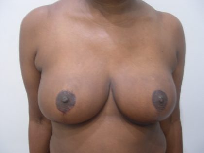 Breast Reduction Before & After Patient #3750