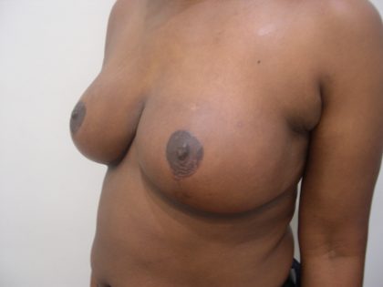 Breast Reduction Before & After Patient #3750