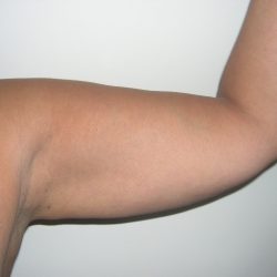 Liposuction Before & After Patient #3814