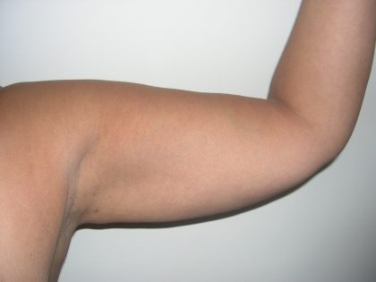 Liposuction Before & After Patient #3814