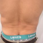 Liposuction Male Before & After Patient #3891