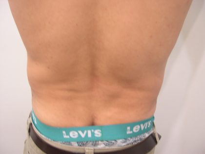 Liposuction Male Before & After Patient #3891