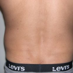 Liposuction Male Before & After Patient #3891