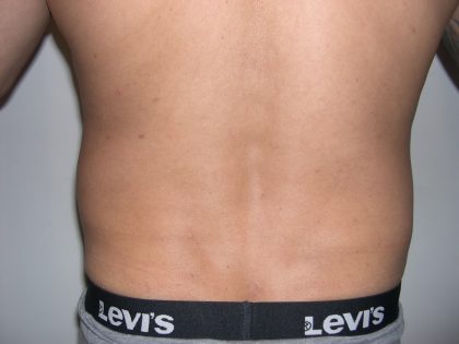 Liposuction Male Before & After Patient #3891