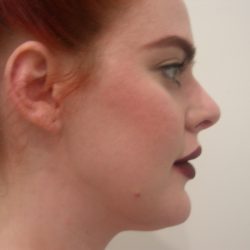 Rhinoplasty Before & After Patient #3861