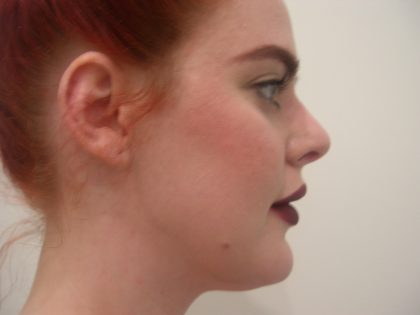 Rhinoplasty Before & After Patient #3861