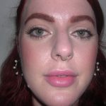 Rhinoplasty Before & After Patient #3861