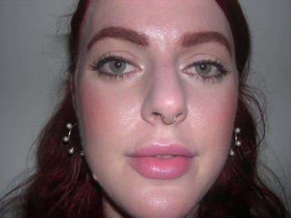 Rhinoplasty Before & After Patient #3861
