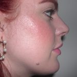 Rhinoplasty Before & After Patient #3861