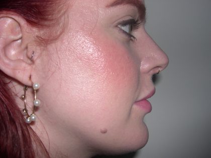 Rhinoplasty Before & After Patient #3861